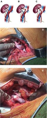 Use of absorbable hemostat bolster for prevention of donor renal artery kinking in kidney transplant